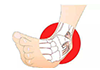脚踝扭伤怎么处理脚踝扭伤正确方法